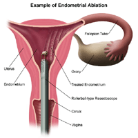 Endometrial Ablation - Hysterectomy Alternative or Trap?- Hormones Matter