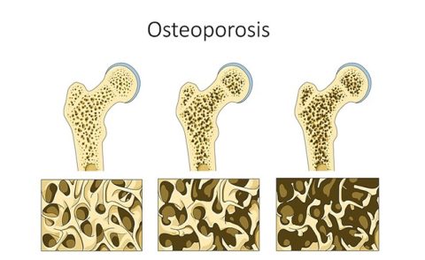 Lupron Induced Osteoporosis? - Hormones Matter