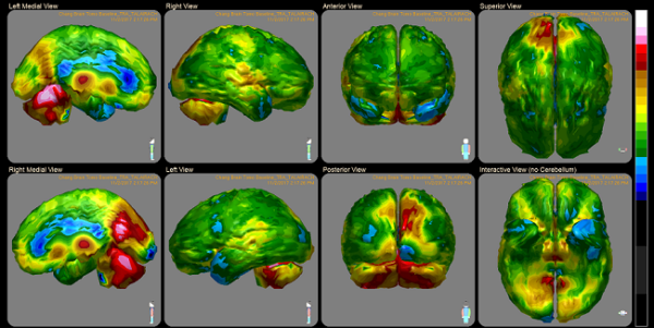 My Brain after Long Term Lexapro: Chemically Induced TBI - Hormones Matter