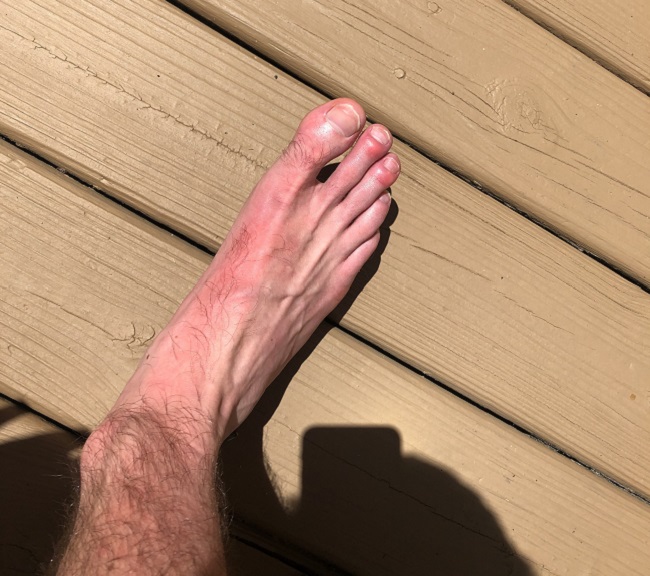 Functional Dysautonomia Affecting Peripheral Circulation Hormones Matter