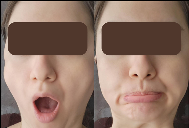 post hyaluronidase syndrome post hyaluronidase syndrome