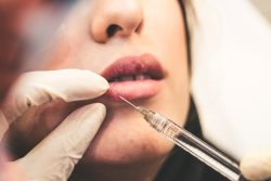 Post Hyaluronidase Syndrome